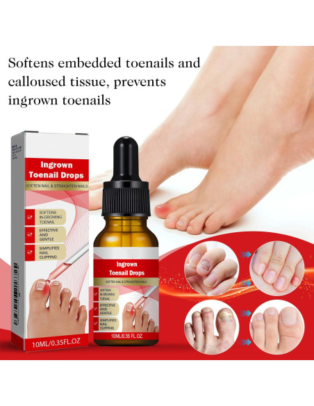 Kit 2 gotas para uñas encarnadas AUJ 10ml - Alivio y suavización Kit 2 gotas para uñas encarnadas AUJ 10ml - Alivio y suavización